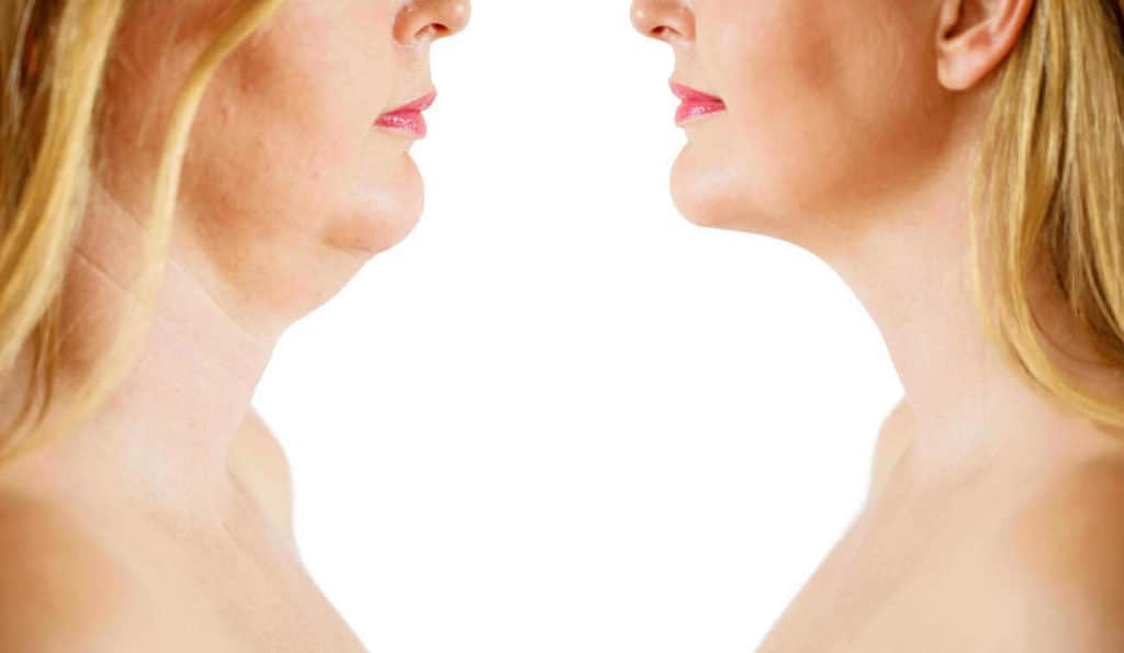 Double Chin treatment Chingford before and after results