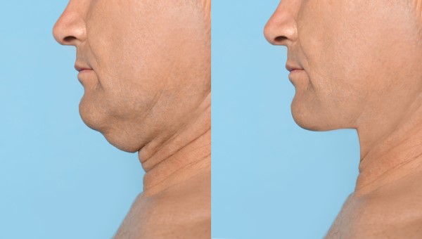 Which Non-Surgical Treatments Work Best for Jowls and Loose Skin Chingford?