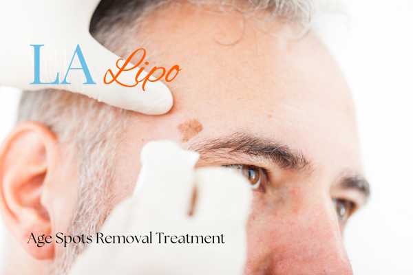 What Are the Most Effective Treatments for Age Spots Chingford?