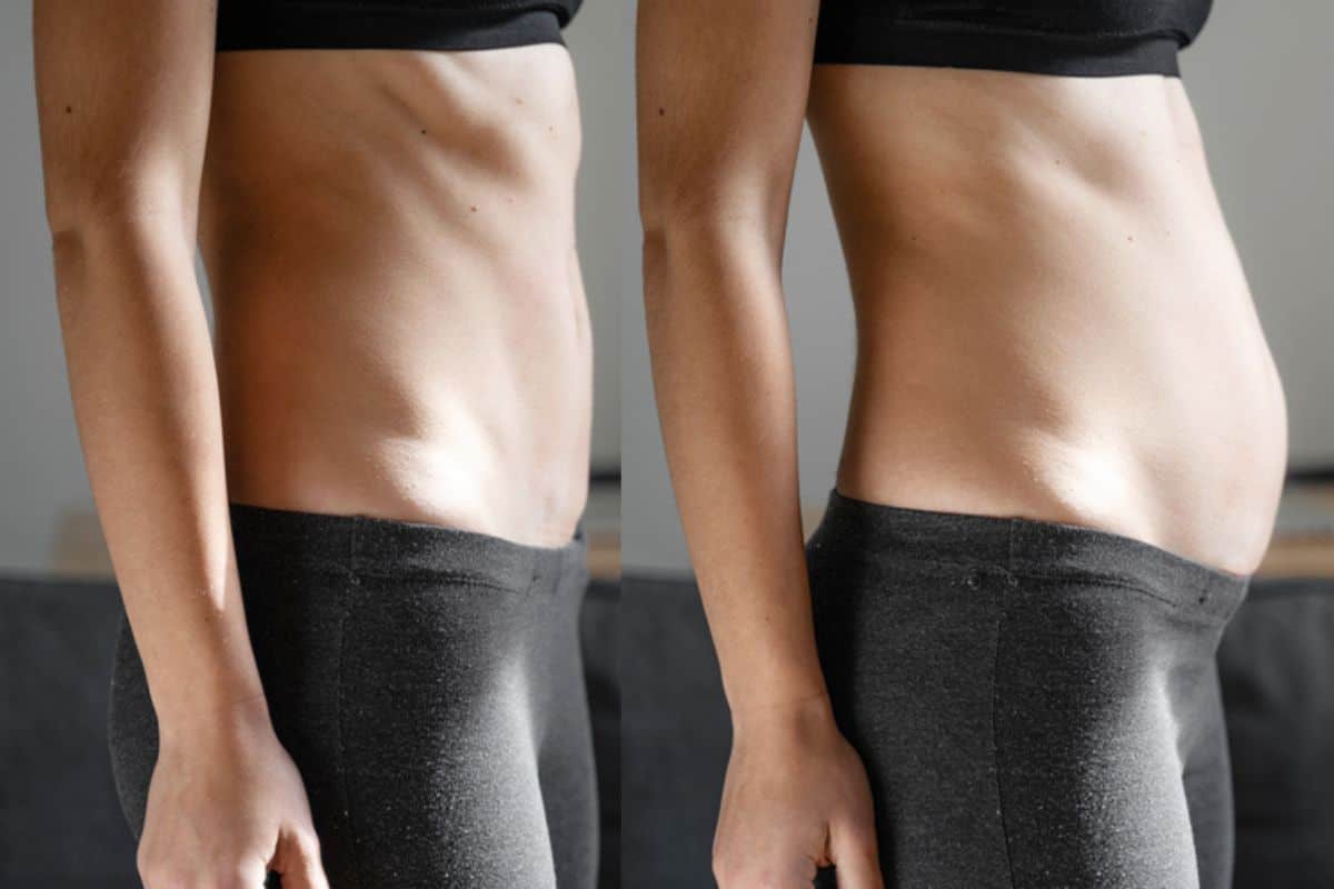How long does diastasis recti take to improve Chingford?