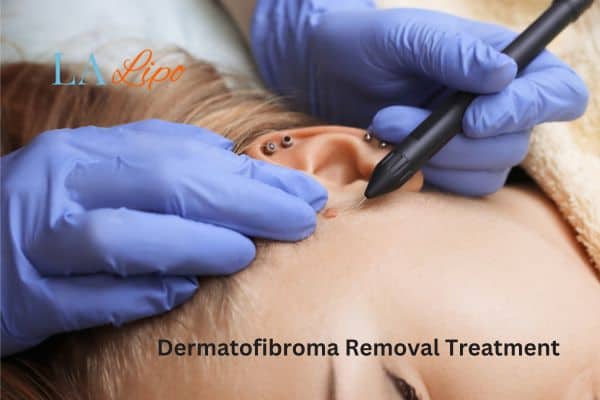 Dermatofibroma Removal Treatment Chingford