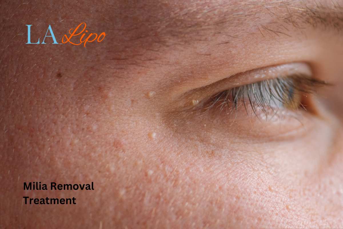 Cryopen Milia Removal: Is It the Easiest and Safest Option Chingford?