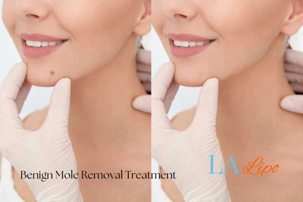 woman's before and after mole removal Chingford results