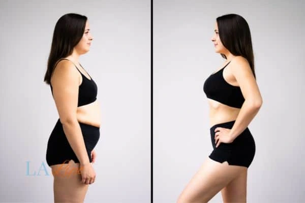 image of woman before and after results of LA-EMS Body Sculpting Chingford to help treat Diastasis recti
