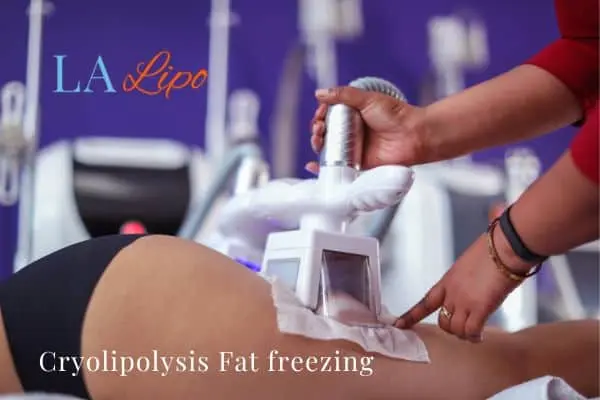 women getting fat freezing Chingford