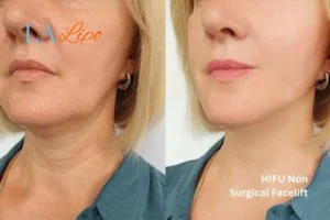 hi-fu for wrinkles Chingford before and after results