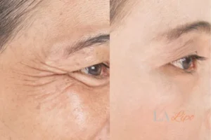 Before and after results of woman - HI-fu wrinkles reduction treatment Chingford