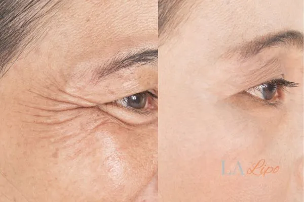 Before and after results of woman - HI-fu wrinkles reduction treatment Chingford
