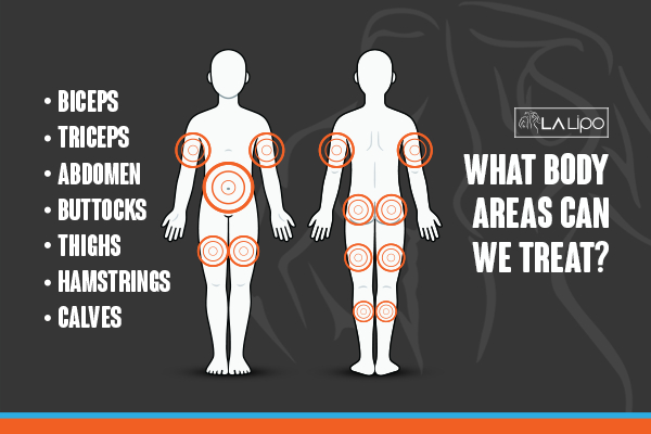 Graphic to show areas you can have LA-EMS Body Sculpting Chingford treatment.
