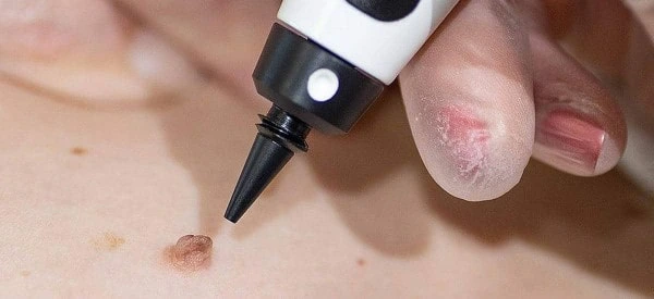 skin tag removal using cryopen Chingford