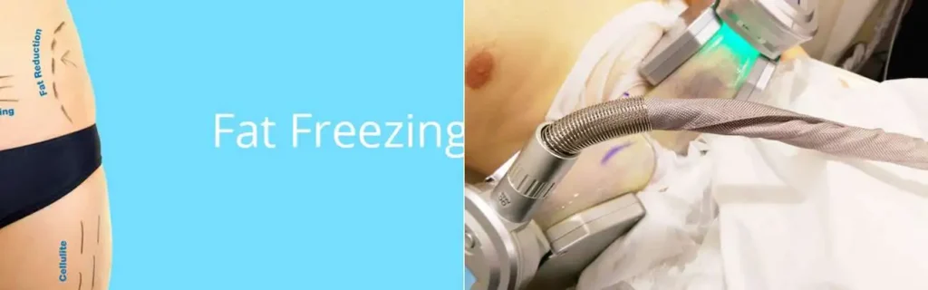 Fat freezing Chingford on multiple areas of the body