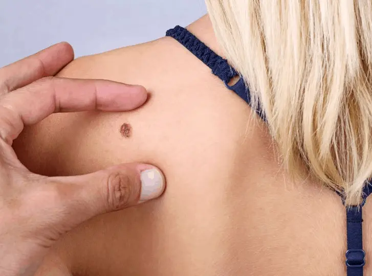 woman having mole removal Chingford consultation before treatment.