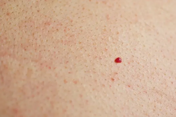 close up of a cherry angioma Chingford