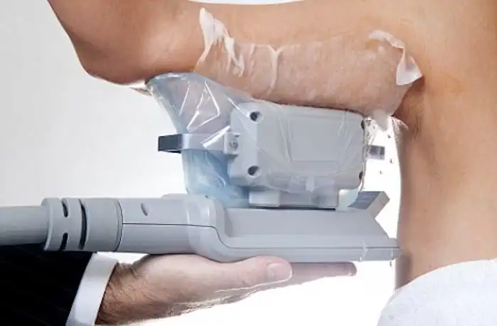 Picture of fat freezing Chingford on the upper arms.