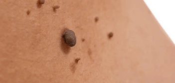 image of a skin tag Chingford