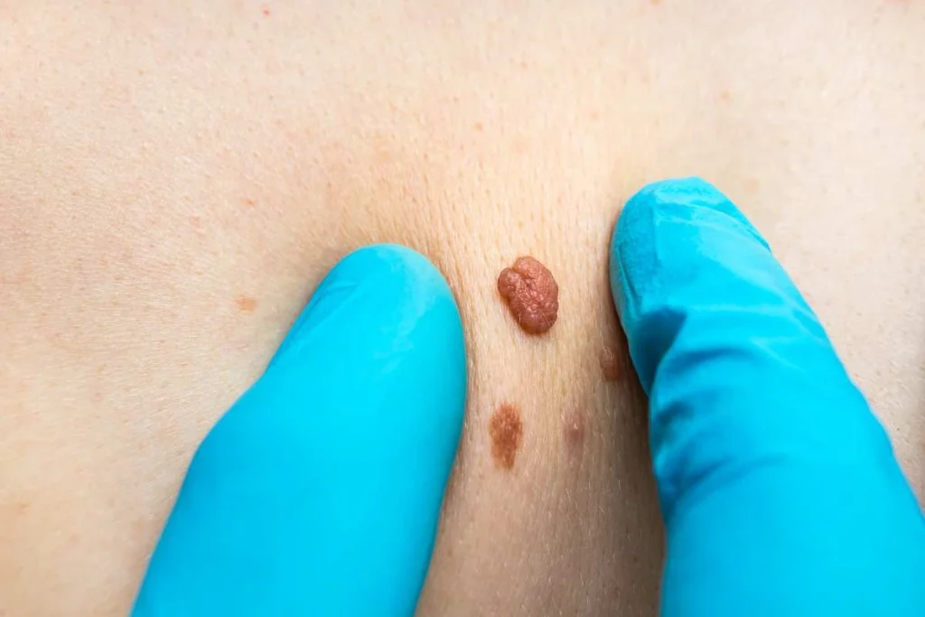 Consultant examining a skin tag Chingford