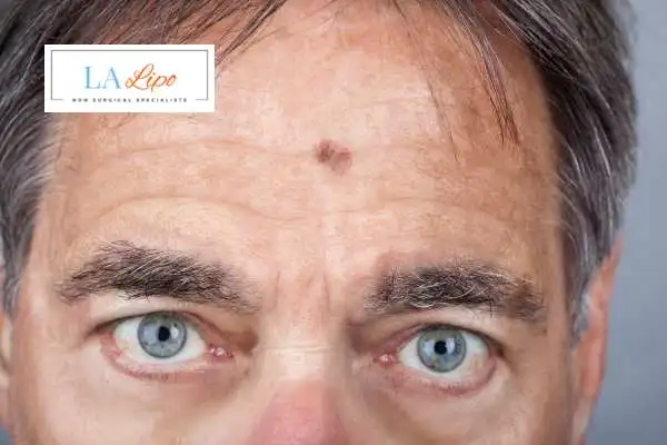Solar Lentigo Removal Chingford image of man with mark on his forehead