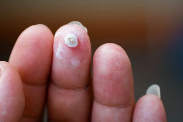 wart on person finger - cryotherapy to treat from LA LIPO Chingford