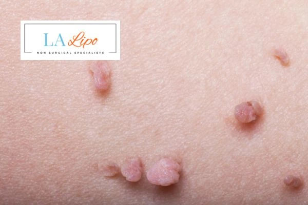 Does cryopen skin tag removal Chingford hurt? Find out now call our team today!