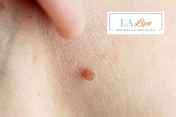 Book skin tag removal Chingford today speak to our team now!
