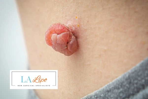 Interested in skin tag removal Chingford? Concerned about the pain? Find out more today!