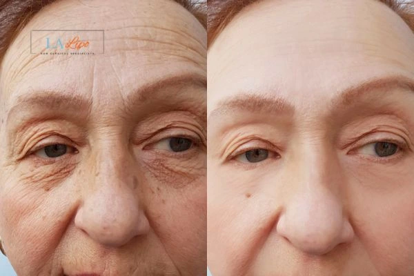 The powerful benefits of Morpheus8 Treatment Chingford - Call Our team today!