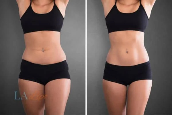 before and after results of non-surgical treatment to help a woman's body image and mental health Chingford