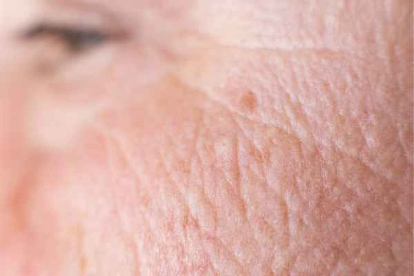 close up picture of a woman's face showing an age spot Chingford