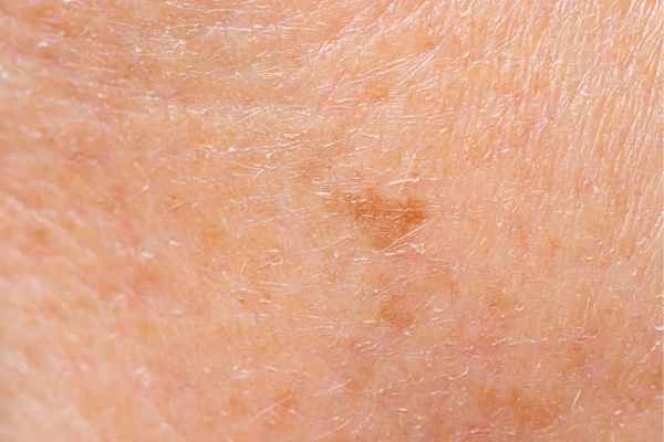 close up picture of age spots Chingford