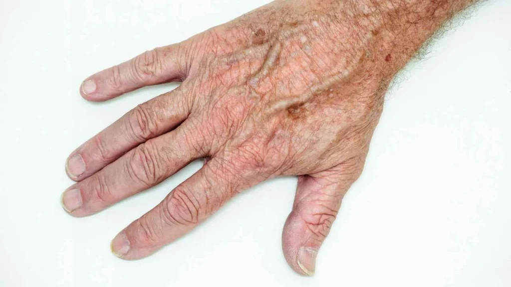 Male hand showing age spot Chingford