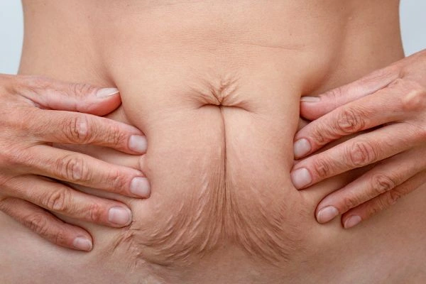 Should I Combine Diastasis Recti Treatment with Body Contouring for Better Results Chingford?