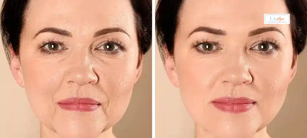 How Long Does It Take to See Results and How Long Do They Last Chingford?