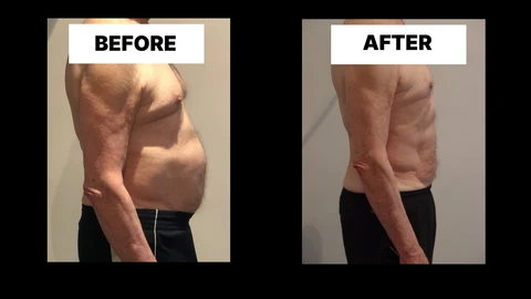 What Symptoms Can Diastasis Recti Cause in Men? Weak Core, Back Pain and Poor Posture Chingford